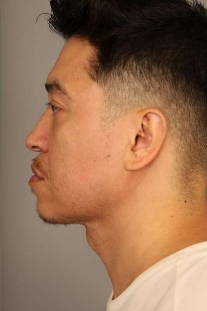 Mini Neck Lift (Single Incision) Before & After Patient #1630