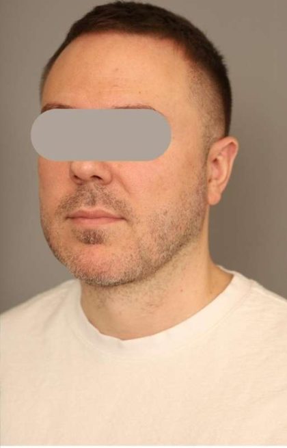 Mini Neck Lift (Single Incision) Before & After Patient #1653