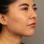Mini Neck Lift (Single Incision) Before & After Patient #1662