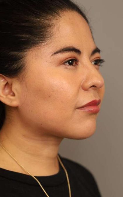 Mini Neck Lift (Single Incision) Before & After Patient #1662