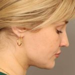 Neck Liposuction / Chin Liposuction Before & After Patient #1703