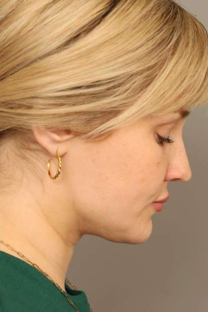 Neck Liposuction / Chin Liposuction Before & After Patient #1703