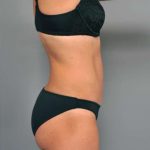 Tummy Tuck Before & After Patient #338