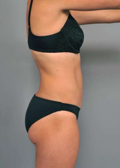 Tummy Tuck Before & After Patient #338
