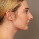 Neck Liposuction / Chin Liposuction Before & After Patient #1734