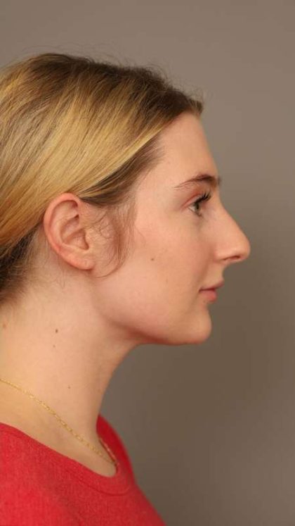 Neck Liposuction / Chin Liposuction Before & After Patient #1734