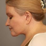 Neck Liposuction / Chin Liposuction Before & After Patient #1743