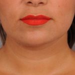 Neck Liposuction / Chin Liposuction Before & After Patient #1770