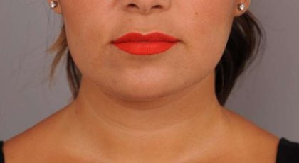 Neck Liposuction / Chin Liposuction Before & After Patient #1770
