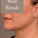 Neck Liposuction / Chin Liposuction Before & After Patient #1794