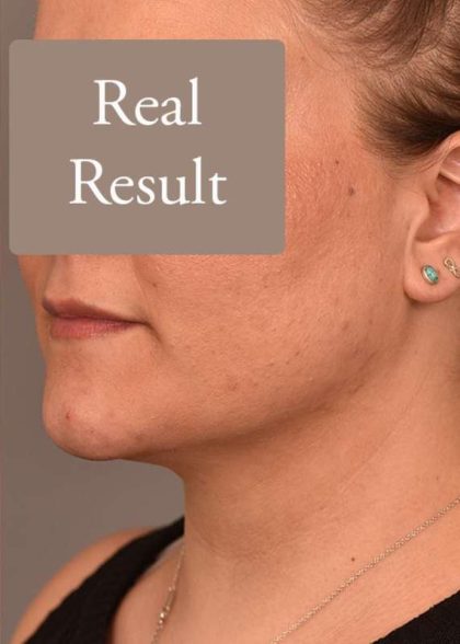 Neck Liposuction / Chin Liposuction Before & After Patient #1794