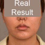 Neck Liposuction / Chin Liposuction Before & After Patient #1801