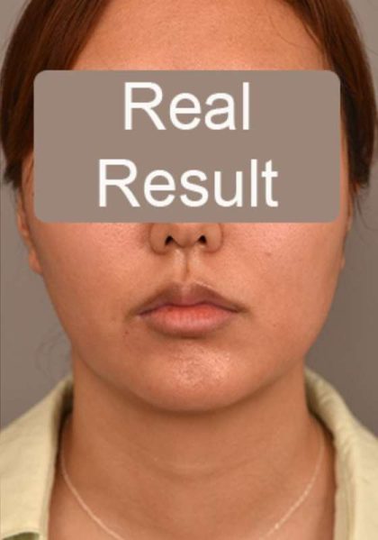 Neck Liposuction / Chin Liposuction Before & After Patient #1801