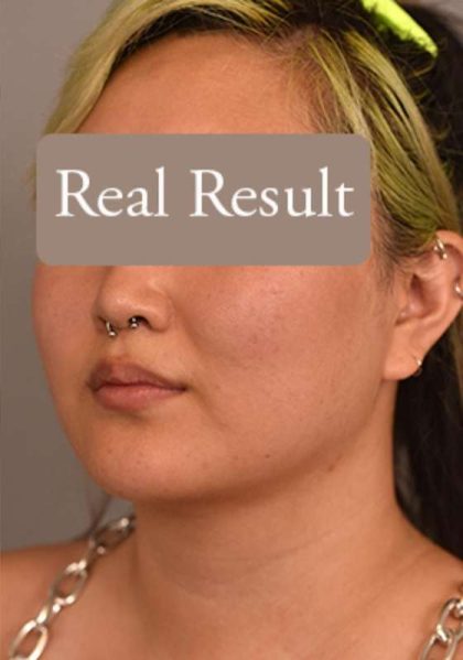 Neck Liposuction / Chin Liposuction Before & After Patient #1816