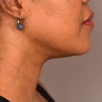 Neck Liposuction / Chin Liposuction Before & After Patient #1824