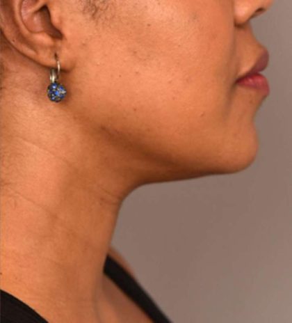 Neck Liposuction / Chin Liposuction Before & After Patient #1824