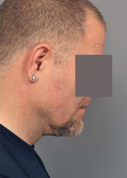 Neck Liposuction / Chin Liposuction Before & After Patient #1831