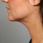 Neck Liposuction / Chin Liposuction Before & After Patient #1839