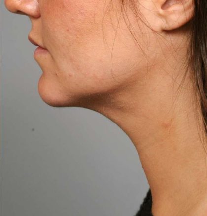 Neck Liposuction / Chin Liposuction Before & After Patient #1839