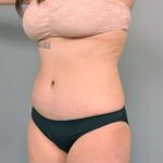 Tummy Tuck Before & After Patient #345
