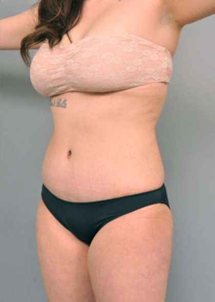 Tummy Tuck Before & After Patient #345