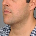 Neck Liposuction / Chin Liposuction Before & After Patient #1846