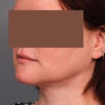 Neck Liposuction / Chin Liposuction Before & After Patient #1854