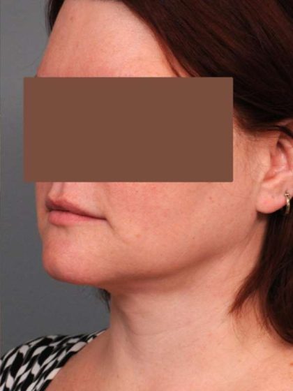 Neck Liposuction / Chin Liposuction Before & After Patient #1854