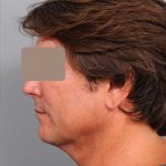 Neck Liposuction / Chin Liposuction Before & After Patient #1877