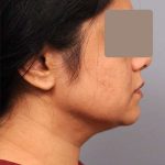 Neck Liposuction / Chin Liposuction Before & After Patient #1893