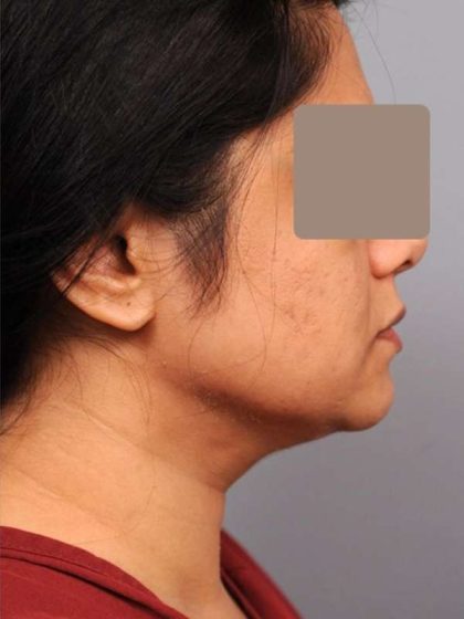 Neck Liposuction / Chin Liposuction Before & After Patient #1893