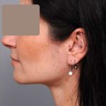 Neck Liposuction / Chin Liposuction Before & After Patient #1913
