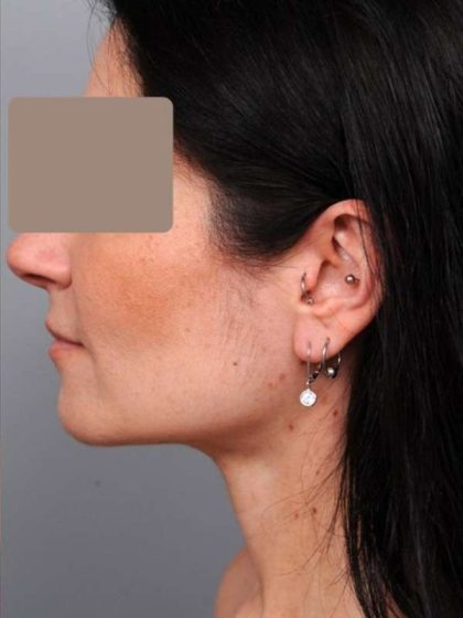 Neck Liposuction / Chin Liposuction Before & After Patient #1913