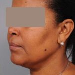 Neck Liposuction / Chin Liposuction Before & After Patient #1930