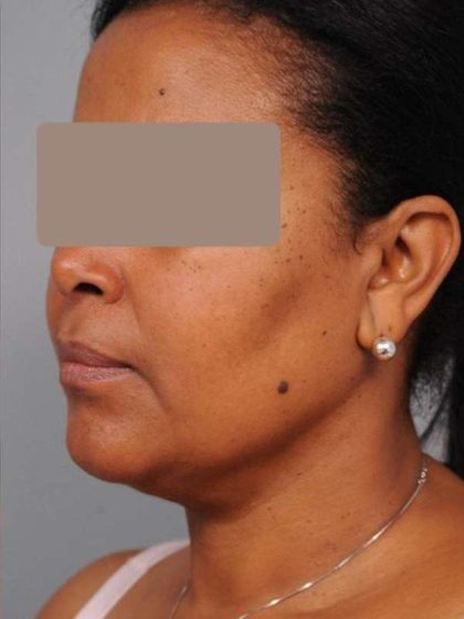 Neck Liposuction / Chin Liposuction Before & After Patient #1930
