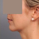 Neck Liposuction / Chin Liposuction Before & After Patient #1937