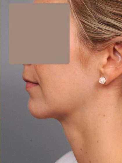 Neck Liposuction / Chin Liposuction Before & After Patient #1937