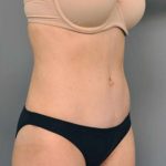 Tummy Tuck Before & After Patient #354