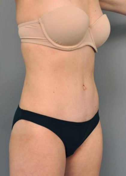 Tummy Tuck Before & After Patient #354