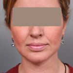 Neck Liposuction / Chin Liposuction Before & After Patient #1946
