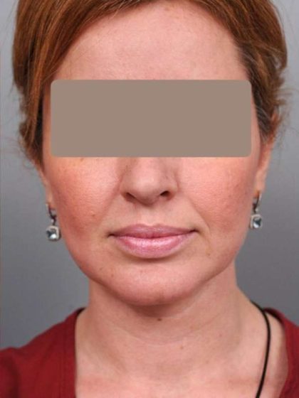 Neck Liposuction / Chin Liposuction Before & After Patient #1946