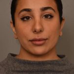 Neck Liposuction / Chin Liposuction Before & After Patient #1953