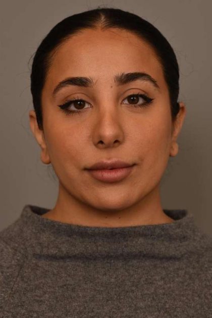 Neck Liposuction / Chin Liposuction Before & After Patient #1953