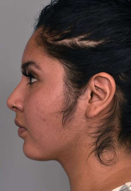 Neck Liposuction / Chin Liposuction Before & After Patient #1990