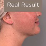 Neck Liposuction / Chin Liposuction Before & After Patient #2002