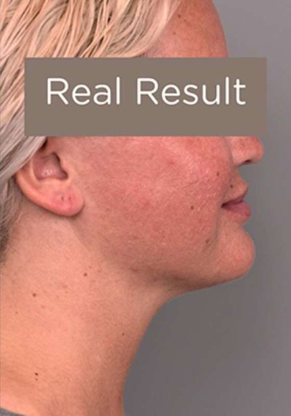 Neck Liposuction / Chin Liposuction Before & After Patient #2002