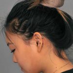 Neck Liposuction / Chin Liposuction Before & After Patient #2011