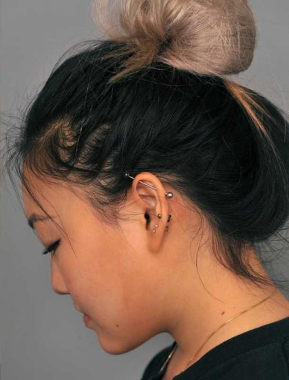 Neck Liposuction / Chin Liposuction Before & After Patient #2011