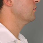 Neck Liposuction / Chin Liposuction Before & After Patient #2027