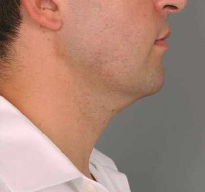 Neck Liposuction / Chin Liposuction Before & After Patient #2027